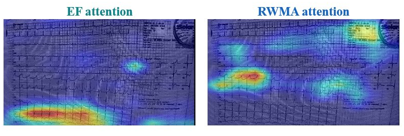 Two ECG photographs overlaid with attention heatmaps, labelled EF attention and RWMA attention, with the hottest regions falling on the rhythm strip and lead complexes